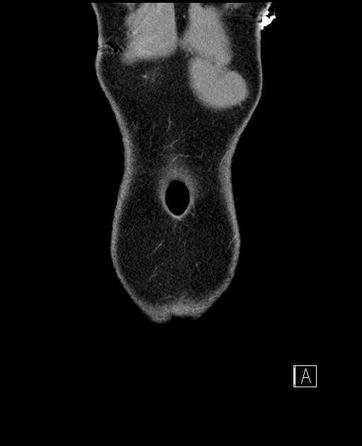 Acute uncomplicated appendicitis (Radiopaedia 61374-69304 Coronal C+ portal venous phase 8).jpg