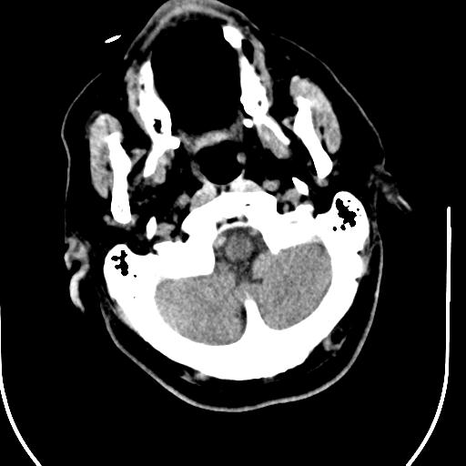 Acute vertebrobasilar ischemic infarction (Radiopaedia 25220-25473 Axial non-contrast 8).jpg