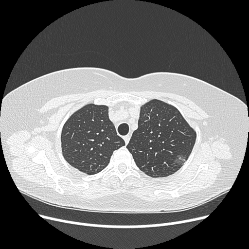 Adenocarcinoma in situ of lung (Radiopaedia 38685-40829 B 48).png