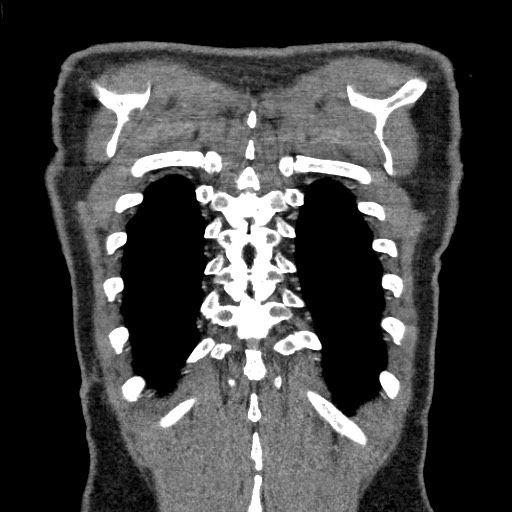 Adenocarcinoma of the lung (Radiopaedia 59871-67325 Coronal C+ arterial phase 67).jpg