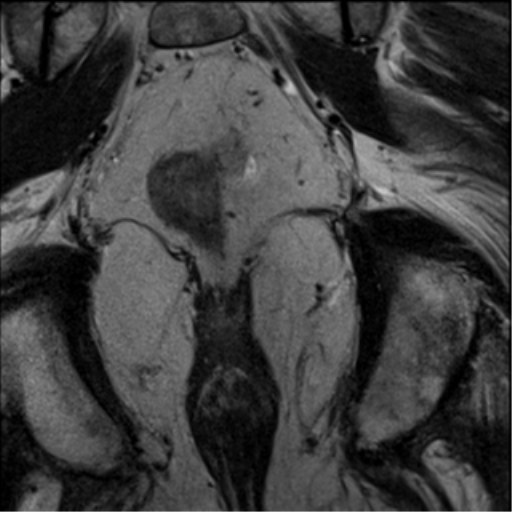 File:Adenocarcioma of rectum- T1 lesion (Radiopaedia 36921-38546 Coronal T2 6).png