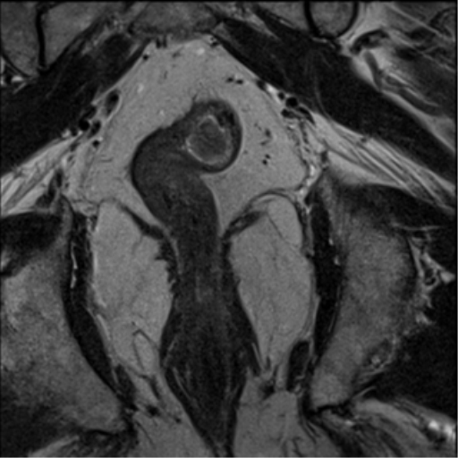 File:Adenocarcioma of rectum- T1 lesion (Radiopaedia 36921-38546 Coronal T2 8).png
