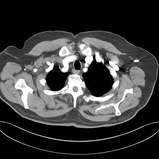 Adenocarcioma of rectum- T1 lesion (Radiopaedia 36921-38547 Axial C+ arterial phase 11).png