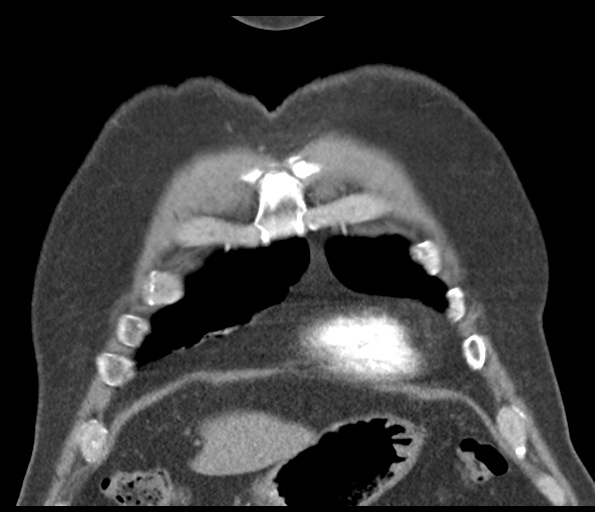 Adenocarcioma of rectum- T1 lesion (Radiopaedia 36921-38547 Coronal C+ arterial phase 14).png