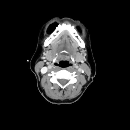 File:Adenoid cystic tumor of palate (Radiopaedia 46980-51518 Axial C+ delayed 42).png