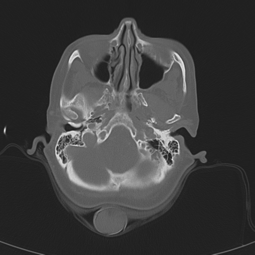 Adenoid cystic tumor of palate (Radiopaedia 46980-51518 Axial bone window 18).png