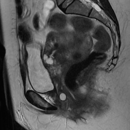 File:Adenoma malignum of cervix (Radiopaedia 66441-75705 Sagittal T2 10).jpg