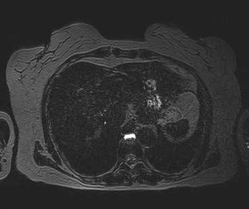 File:Adenomyomatosis of the gallbladder (Radiopaedia 50246-55587 Axial 1).png