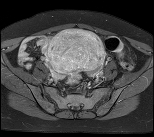 File:Adenomyosis - ovarian endometriomas (Radiopaedia 67031-76350 Axial T1 C+ fat sat 9).jpg