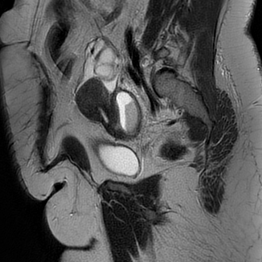 File:Adenomyosis within a didelphys uterus (Radiopaedia 70175-80215 Sagittal T2 26).jpg