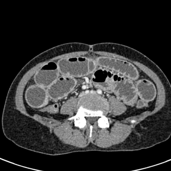 Adhesional small bowel obstruction (Radiopaedia 48397-53305 Axial C+ portal venous phase 55).jpg