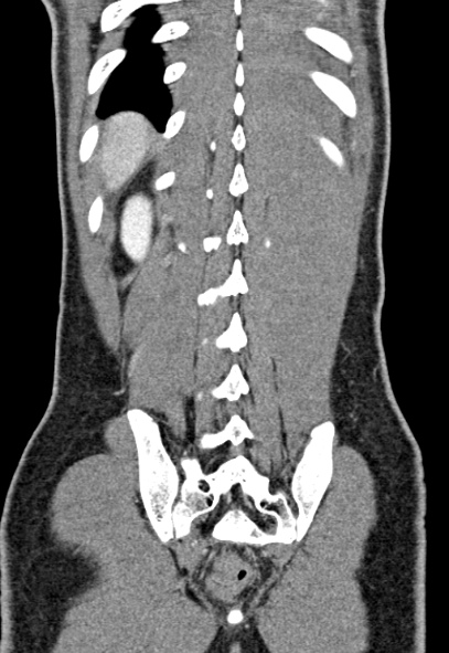 Adhesional small bowel obstruction (Radiopaedia 52107-57980 Coronal C+ portal venous phase 70).jpg