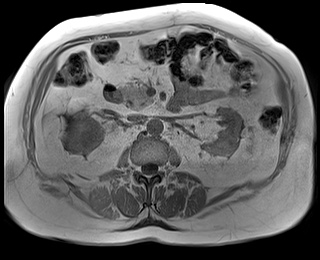 File:Adrenal cortical carcinoma (Radiopaedia 64017-72770 Axial T1 in-phase 40).jpg