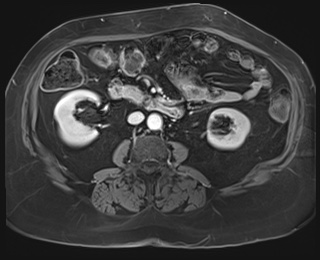 Adrenal cortical carcinoma (Radiopaedia 64017-72770 J 52).jpg