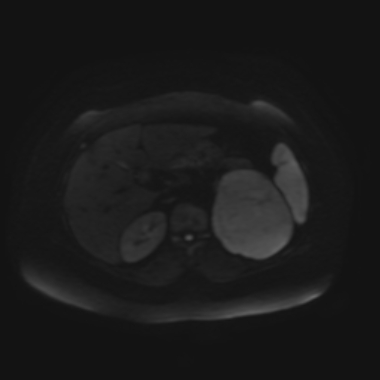 Adrenal cortical carcinoma (Radiopaedia 70906-81116 Axial DWI 39).jpg