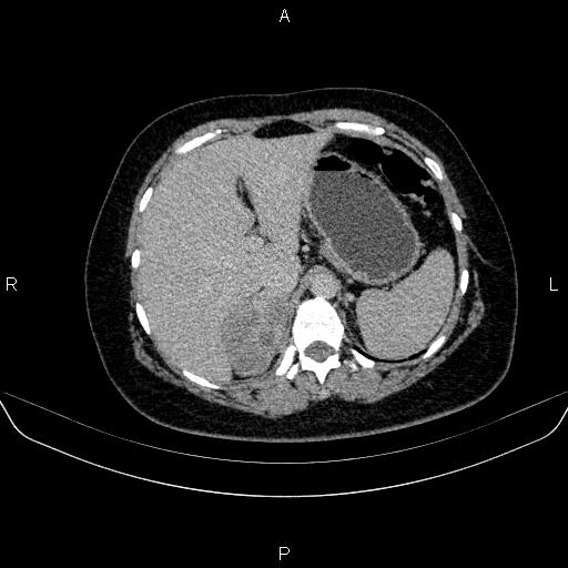 Adrenal cortical carcinoma (Radiopaedia 84882-100379 Axial C+ delayed 18).jpg