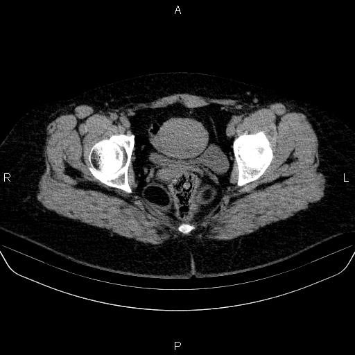 File:Adrenal cortical carcinoma (Radiopaedia 84882-100379 Axial non-contrast 90).jpg