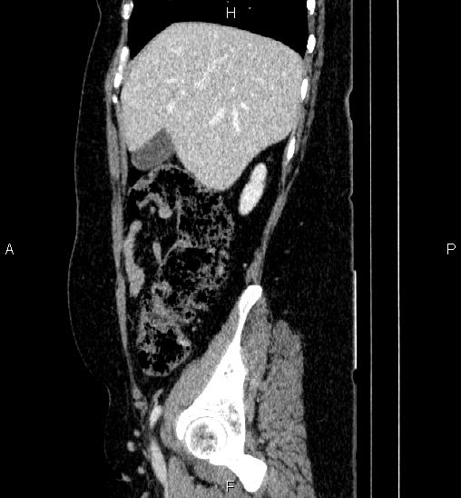 Adrenal cortical carcinoma (Radiopaedia 84882-100379 Sagittal C+ portal venous phase 20).jpg
