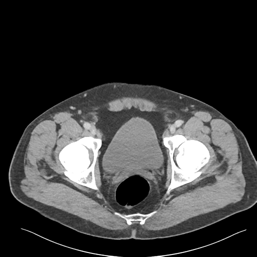 Adrenal cyst (Radiopaedia 45625-49777 Axial C+ portal venous phase 95).png