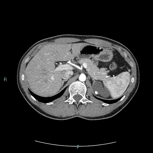Adrenal cystic lymphangioma (Radiopaedia 83161-97534 Axial C+ arterial phase 28).jpg