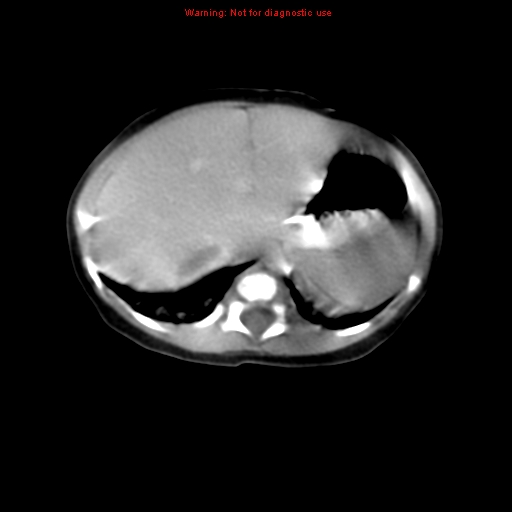 File:Adrenal hemorrhage (Radiopaedia 9390-10077 Axial C+ portal venous phase 2).jpg