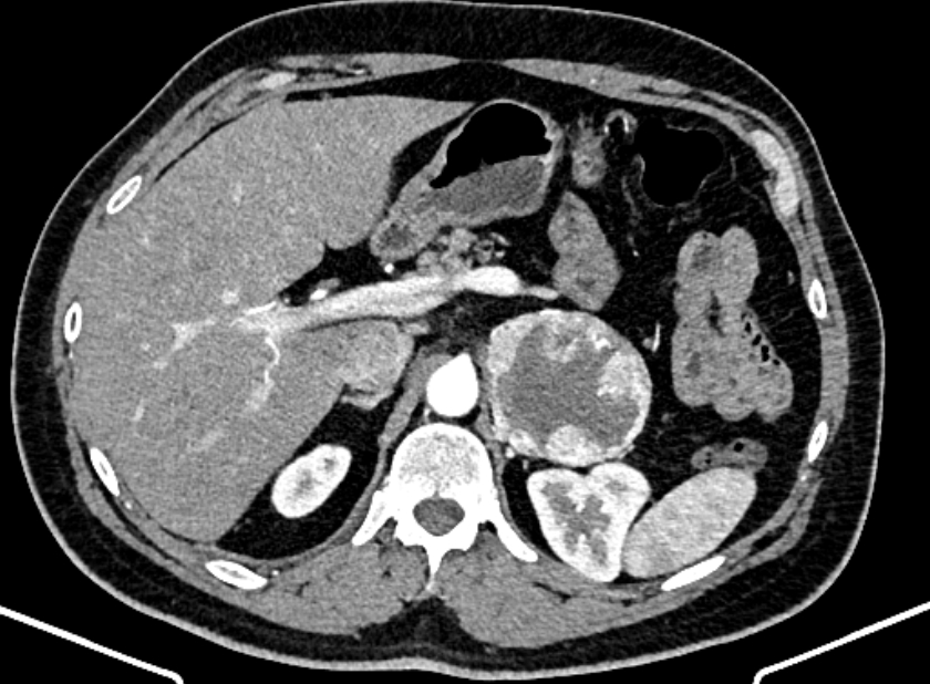 Adrenal metastases (Radiopaedia 73082-83791 Axial C+ arterial phase 49).jpg