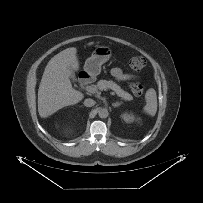 Adrenal myelolipoma (Radiopaedia 26278-26407 Axial non-contrast 19).jpg