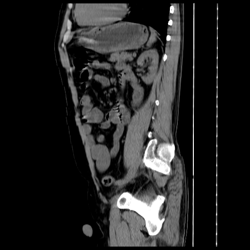 File:Adrenal myelolipoma (Radiopaedia 41843-44834 Sagittal non-contrast 28).jpg