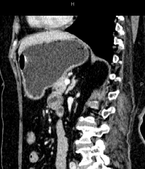 Adrenal myelolipoma (Radiopaedia 82742-96986 Sagittal renal cortical phase 66).jpg