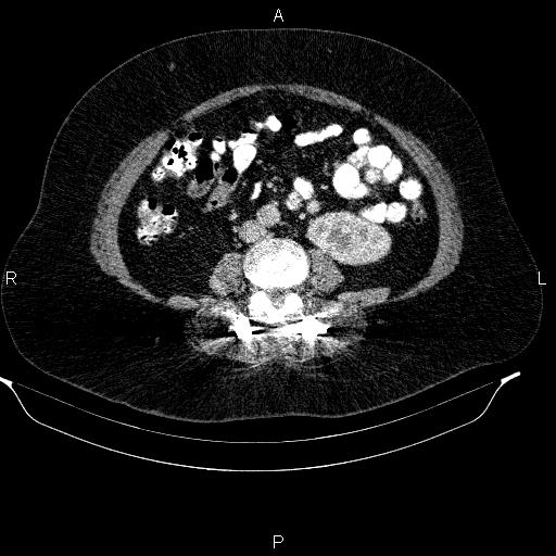 Adrenal myelolipoma (Radiopaedia 84319-99617 Axial renal cortical phase 65).jpg
