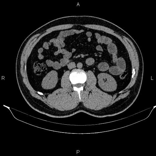 Adrenal myelolipoma (Radiopaedia 84321-99619 Axial non-contrast 54).jpg