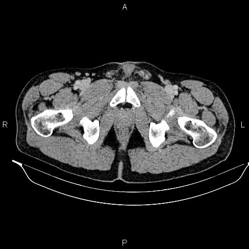 Adrenal myelolipoma (Radiopaedia 87794-104246 Axial renal cortical phase 111).jpg