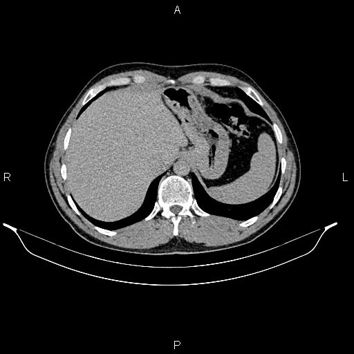 Adrenal myelolipoma (Radiopaedia 87794-104246 Axial renal excretory phase 17).jpg