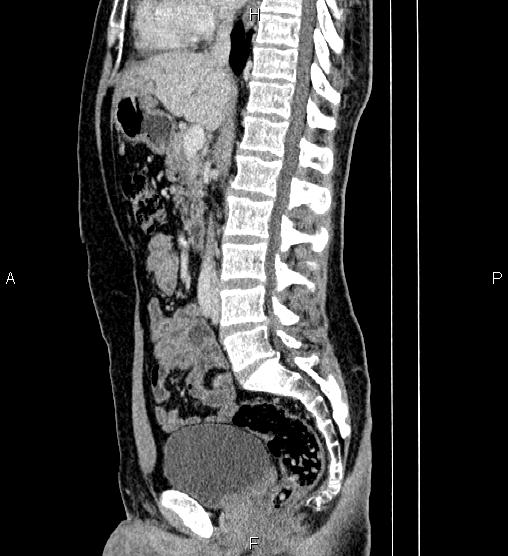 Adrenal myelolipoma (Radiopaedia 87794-104246 Sagittal renal cortical phase 46).jpg