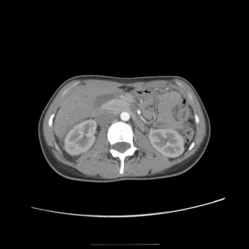 Adult polycystic kidney disease (Radiopaedia 48845-53876 Axial renal cortical phase 27).jpg