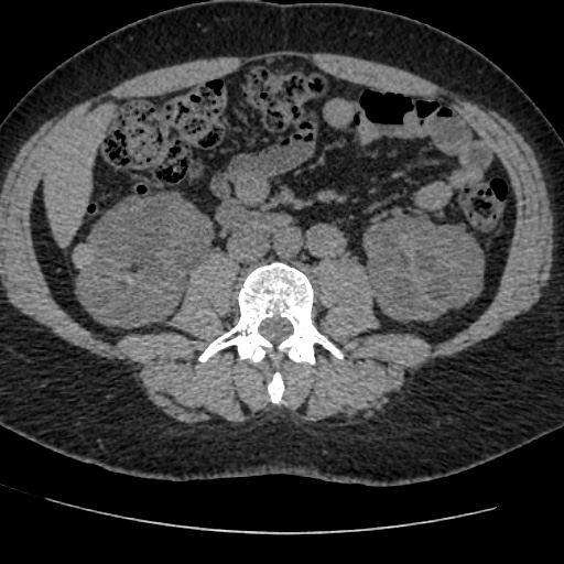 Adult polycystic kidney disease (Radiopaedia 59075-66368 Axial non-contrast 45).jpg