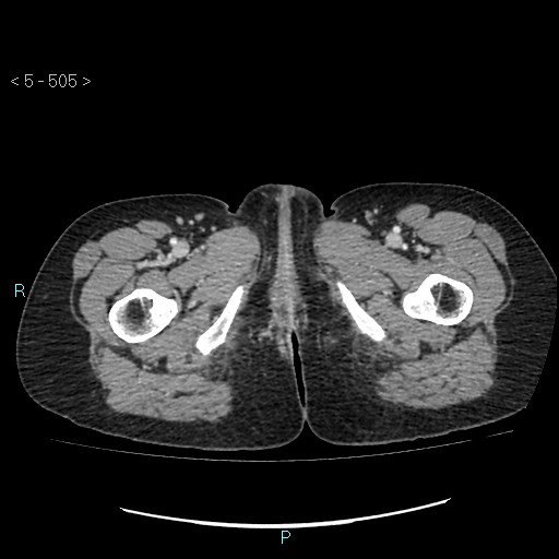File:Adult transient intestinal intussusception (Radiopaedia 34853-36310 Axial C+ portal venous phase 139).jpg