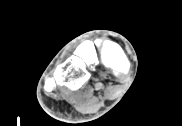 File:Advanced osteomyelitis due to open metatarsal fracture (Radiopaedia 83891-99095 Axial non-contrast 21).jpg
