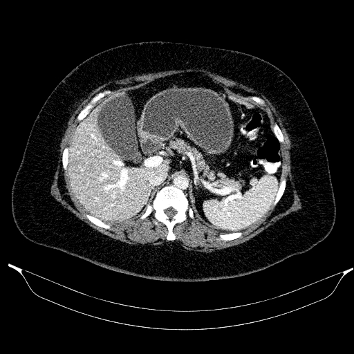 Afferent loop syndrome - secondary to incarcerated trocar site hernia (Radiopaedia 82959-97305 Axial C+ portal venous phase 66).jpg