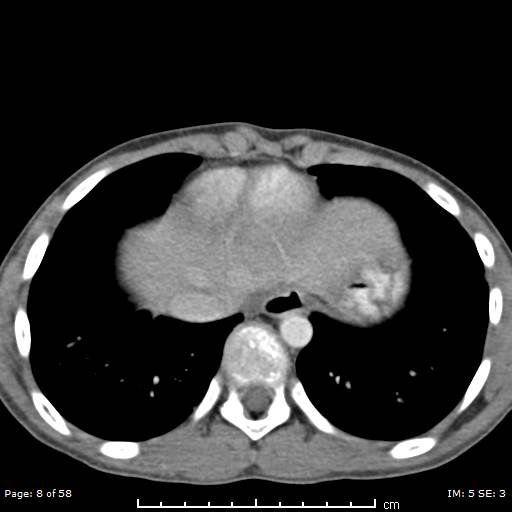 File:Agenesis of the gallbladder (Radiopaedia 55454-61905 B 8).jpg
