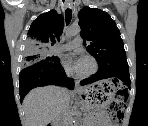 Air bronchogram in pneumonia (Radiopaedia 85719-101512 Coronal non-contrast 27).jpg