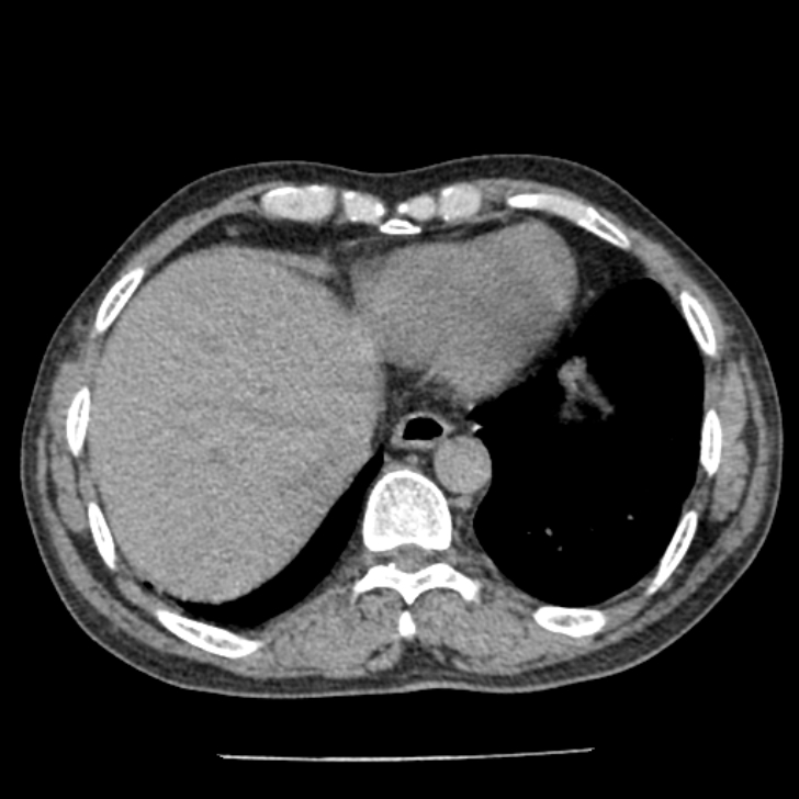 Airway foreign body in adult (Radiopaedia 85907-101779 Axial liver window 154).jpg