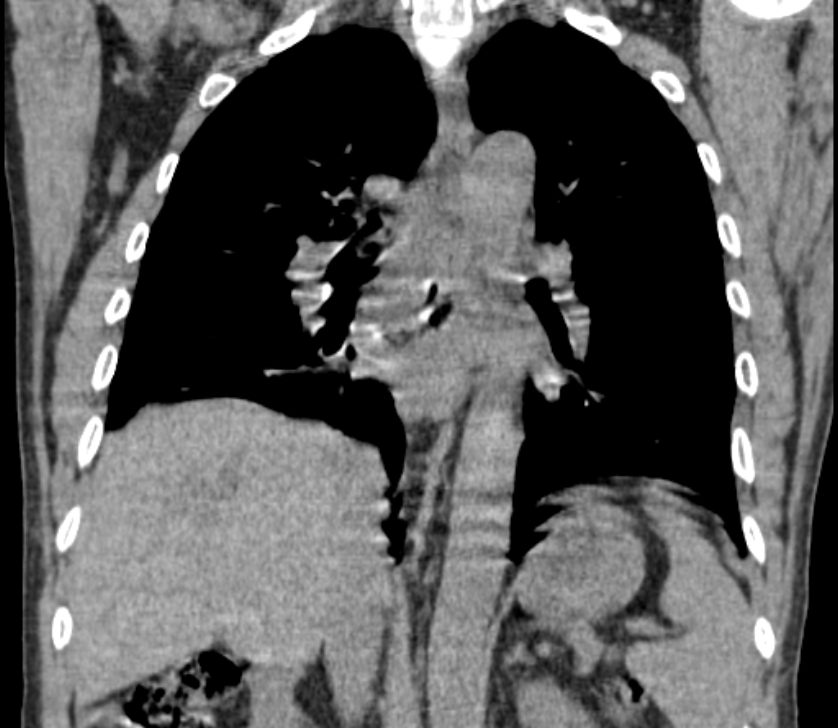 Airway foreign body in adult (Radiopaedia 85907-101779 Coronal liver window 164).jpg
