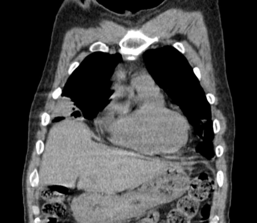 Airway foreign body in adult (Radiopaedia 85907-101779 Coronal liver window 53).jpg