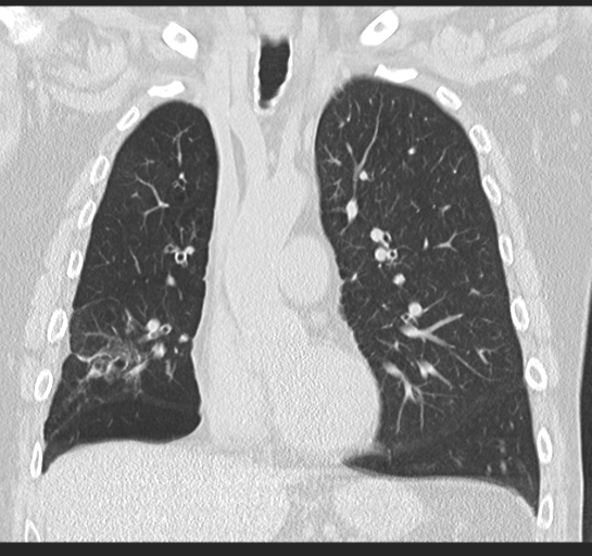 Allergic bronchopulmonary aspergillosis (Radiopaedia 44760-48571 Coronal lung window 25).png