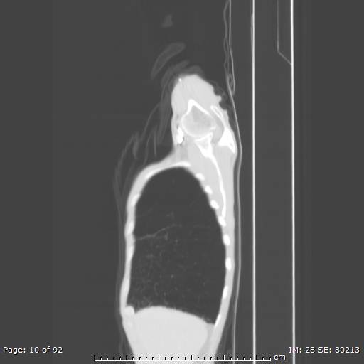 File:Alpha-1-antitrypsin deficiency (Radiopaedia 50561-55987 Sagittal lung window 5).jpg
