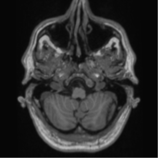 Alzheimer's disease- with Gerstmann syndrome and dressing apraxia (Radiopaedia 54882-61150 Axial T1 11).png