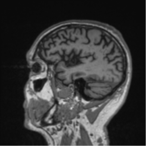 Alzheimer's disease- with Gerstmann syndrome and dressing apraxia (Radiopaedia 54882-61150 Sagittal T1 14).png