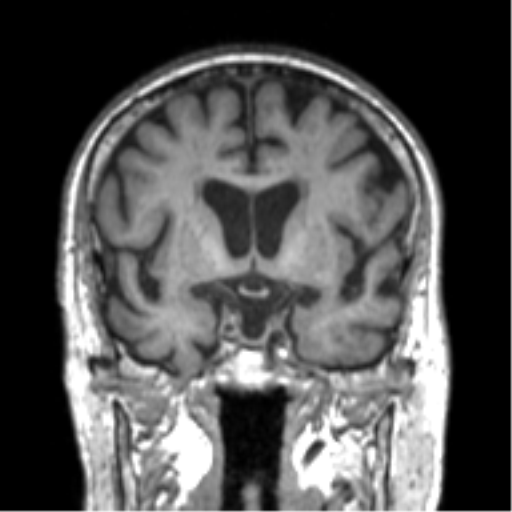 Alzheimer disease and cerebral amyloid angiopathy (Radiopaedia 64234-73011 Coronal T1 41).png