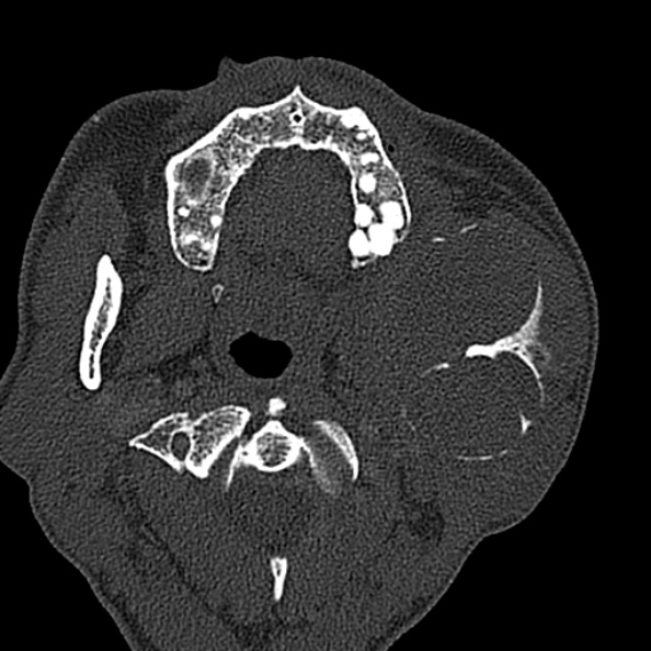 Ameloblastoma (Radiopaedia 51921-57766 Axial bone window 102).jpg